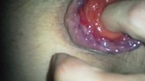 sex анальный пролапс porn